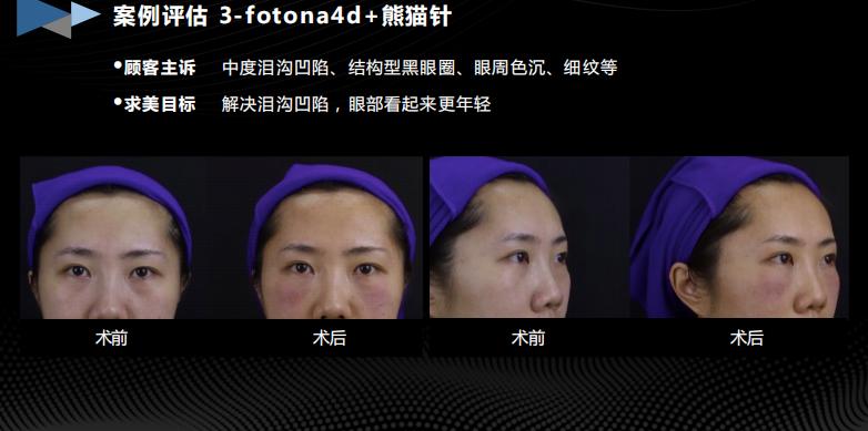 胶生灌养眼周抗衰是什么产品？