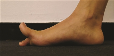 脚趾为什么那么不灵活,脚踝扭伤后恢复后脚趾头不灵活