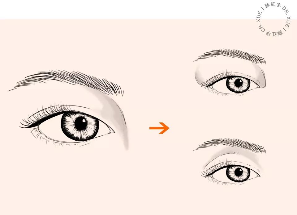 三层眼皮女人的特点,哪种眼皮最好看