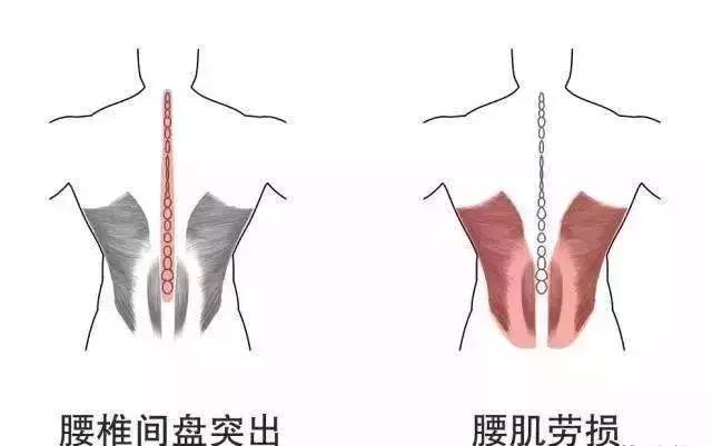 腰疼怎么区分是腰肌劳损还是肾病,腰疼是不是腰椎间盘突出怎么区分