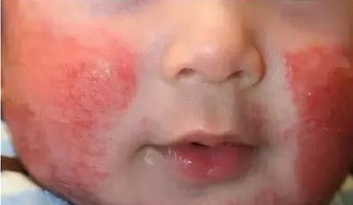 新生儿痱子怎么治好得快,新生儿痱子的最佳治疗方法