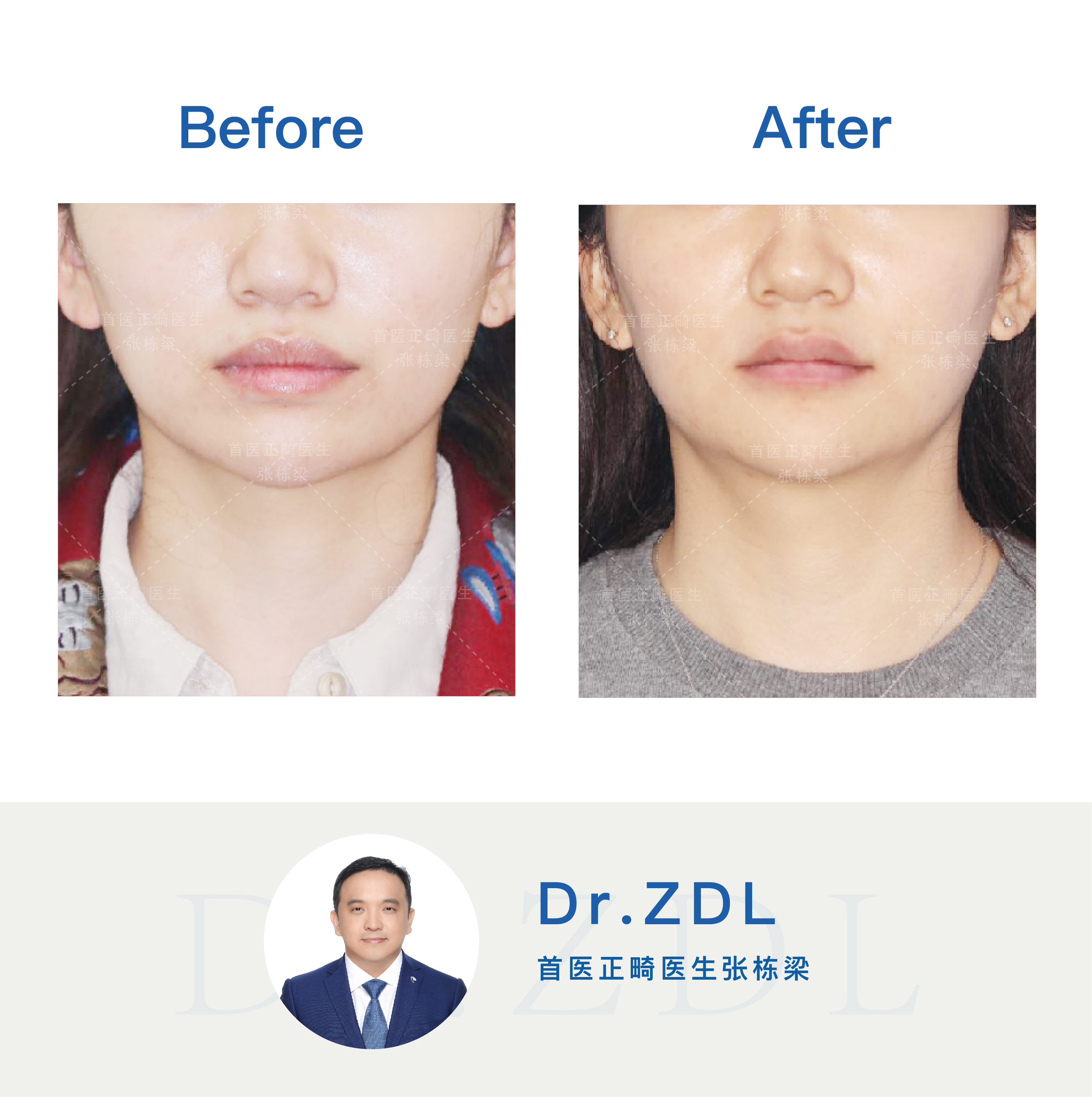 做了烤瓷桥还能正颌吗,做了烤瓷桥还能做钢牙吗