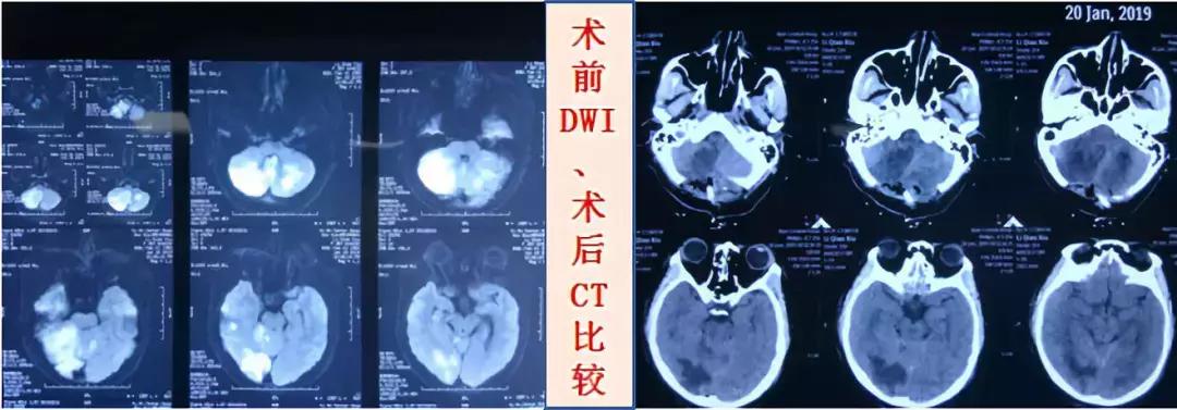脑卒中隐形杀手,右侧小脑半球急性脑梗死能治好吗