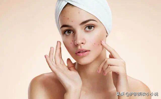 红色痘印怎么去除用什么护肤品,如何祛红痘印最有效简单方法