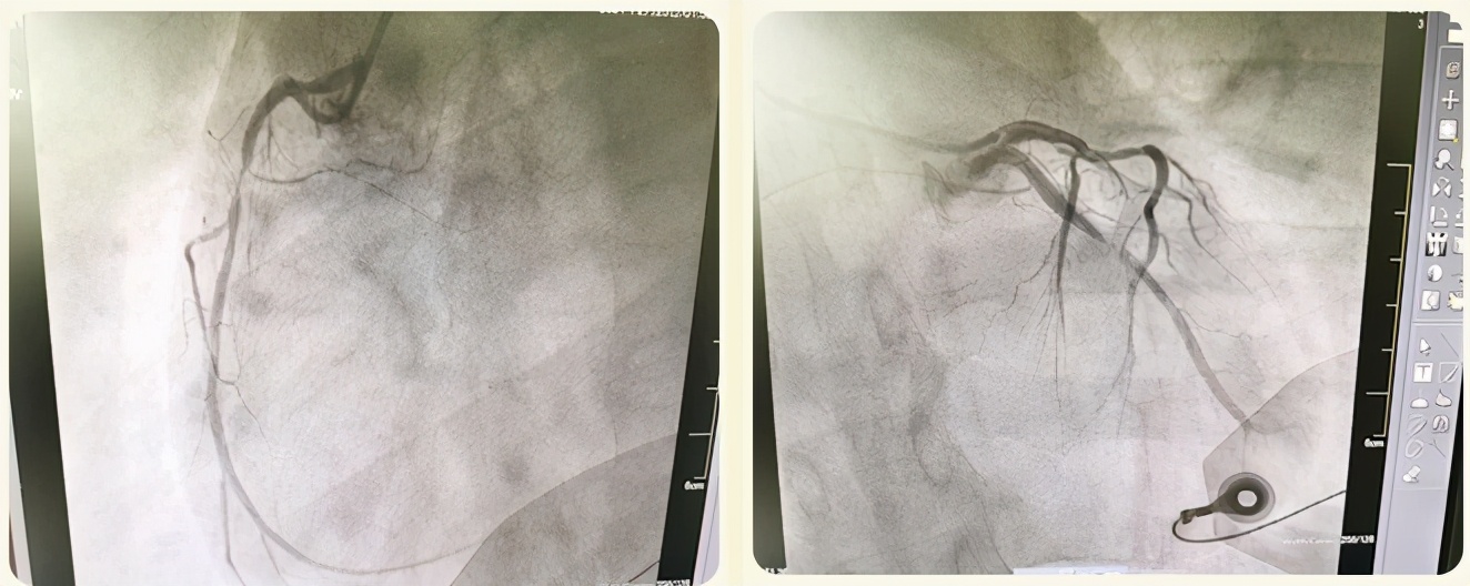 急性心肌梗塞的急救与护理措施,心内科抢救
