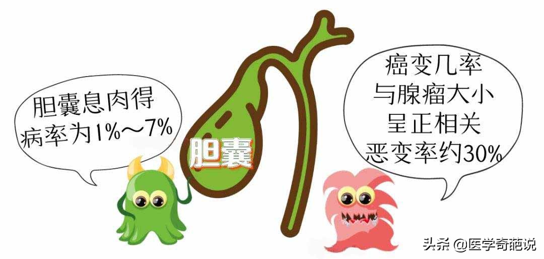 多发性胆囊息肉1.0癌变几率大吗,胆囊息肉几年没有长大需切除吗