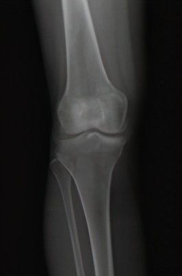 膝关节阶梯治疗ppt,膝关节骨性关节炎阶梯化治疗