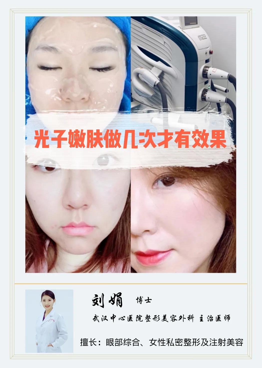 光子嫩肤做几次才有效果,光子嫩肤后可以上班吗