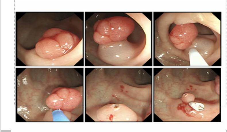 胃肠息肉会癌变么,长蒂息肉和无蒂息肉哪种容易癌变