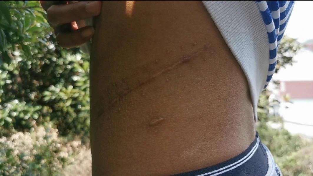 卖肾换苹果手机的高中生,高中生卖肾换iphone手机