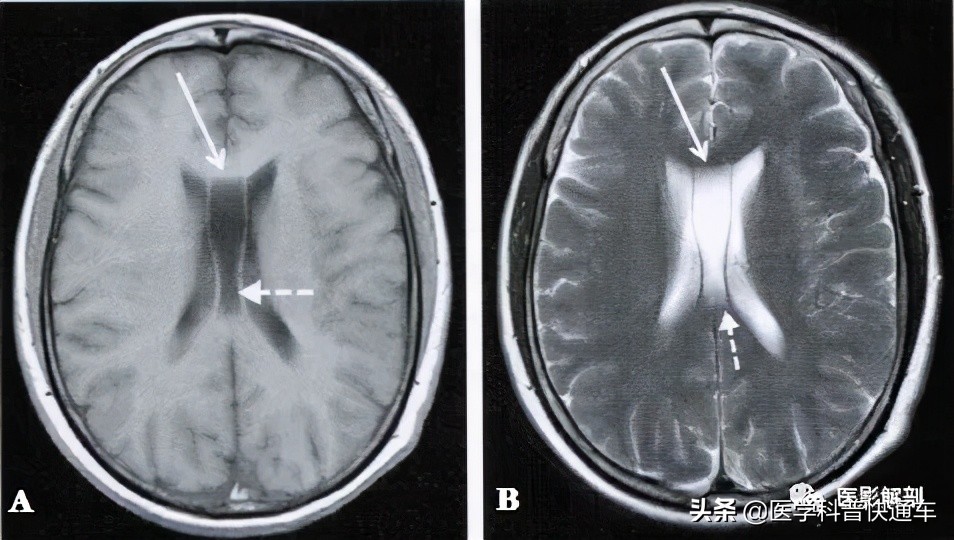 成人透明隔间腔增宽意味什么,透明隔间腔和vergae的区别