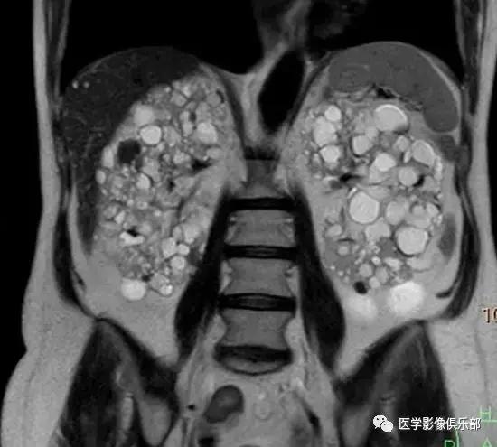双肾多发小囊肿到底是不是多囊肾,肾多发囊肿与多囊肾的超声鉴别