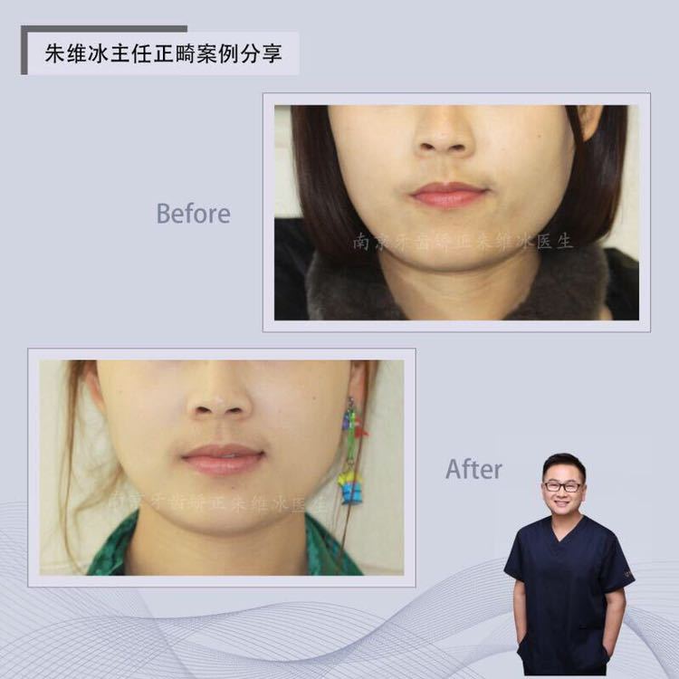 南京正畸朱维冰怎么样,南京牙齿正畸矫正技术