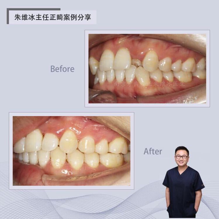 南京正畸朱维冰怎么样,南京牙齿正畸矫正技术