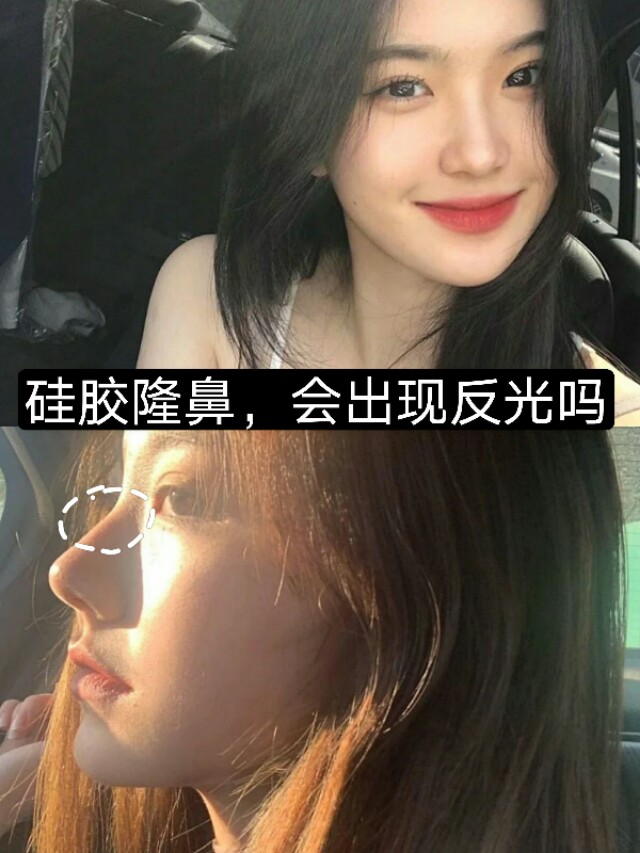 硅胶隆鼻会透光么,硅胶隆鼻会出现骨吸收的问题吗