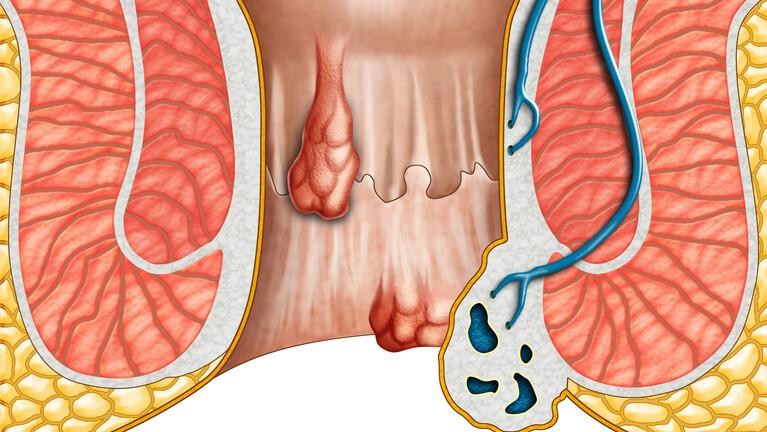 痔疮初期患者请注意，不疼不痒别大意，小心这些问题找上你