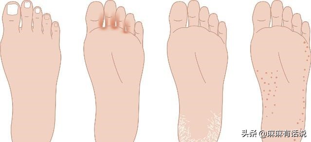 孩子不爱穿鞋好处,孩子不爱穿鞋对身体的危害