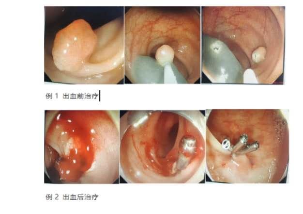 肠息肉切除夹子掉了会出血吗,肠息肉手术夹子脱落会出血吗