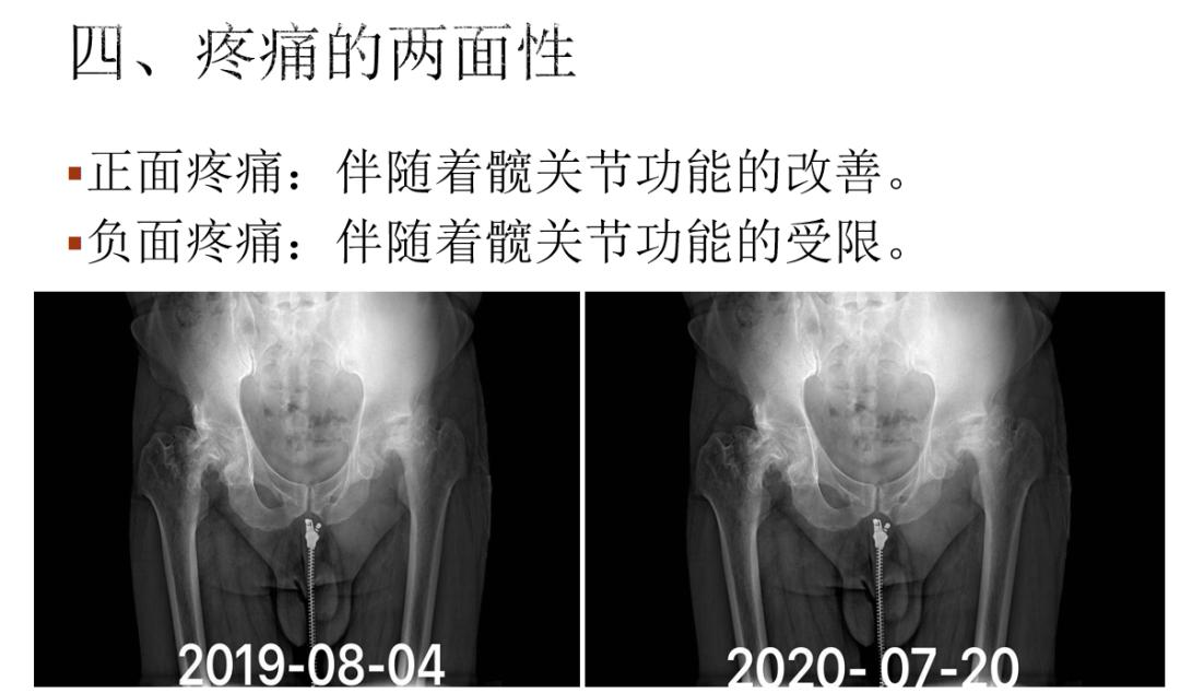 对股骨头缺血性坏死疼痛的治疗体会