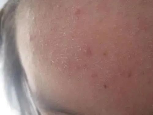 在空调屋里皮肤干燥、瘙痒、泛红，我来帮你解决