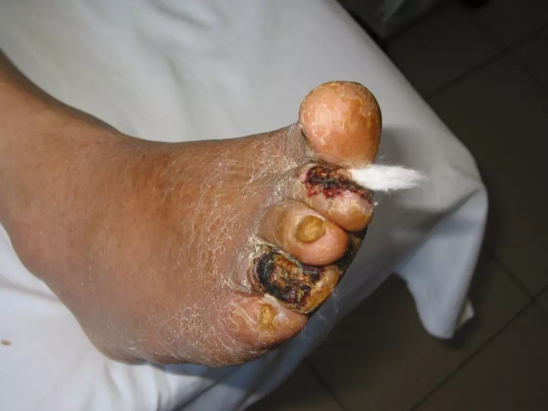 老年人腿疼怎么判断是骨质疏松,老年人腿脚无力是什么病