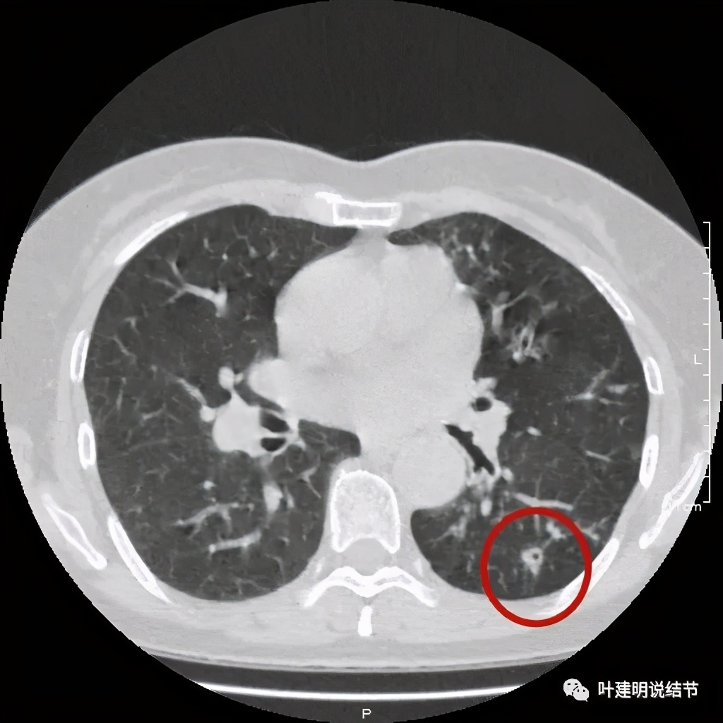 这样的实性结节伴小空洞会是肺癌吗?