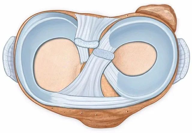 半月板手术导致骨性关节炎怎么办,关节镜治疗半月板损伤后遗症