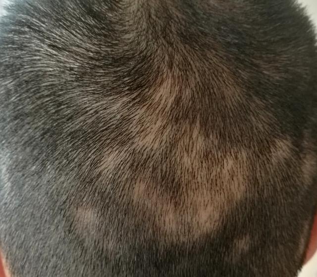 病理性脱发,偏执性脱发