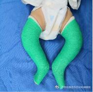 马蹄内翻足孩子的康复,成人马蹄足内翻康复治疗