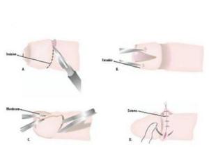 中年人做包皮手术多少天恢复好,手工切包皮