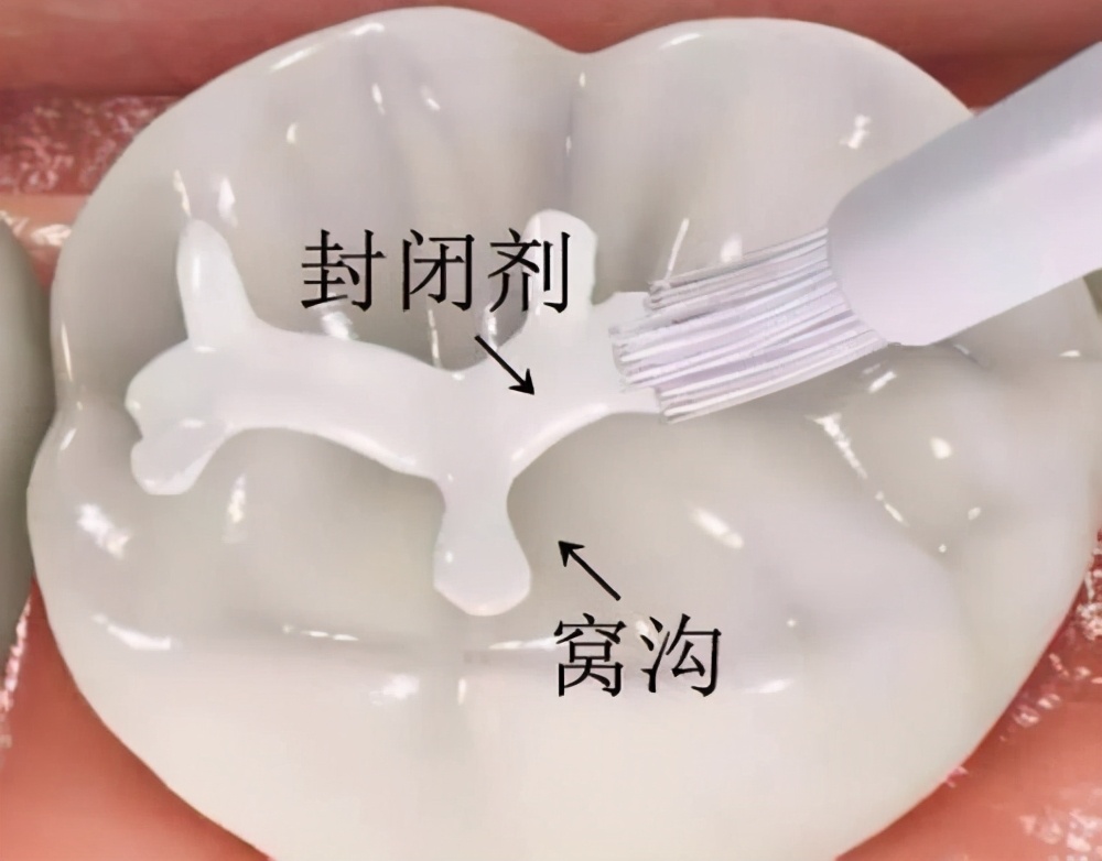 窝沟封闭预防儿童蛀牙的好方法,儿童窝沟封闭预防龋齿有什么危险