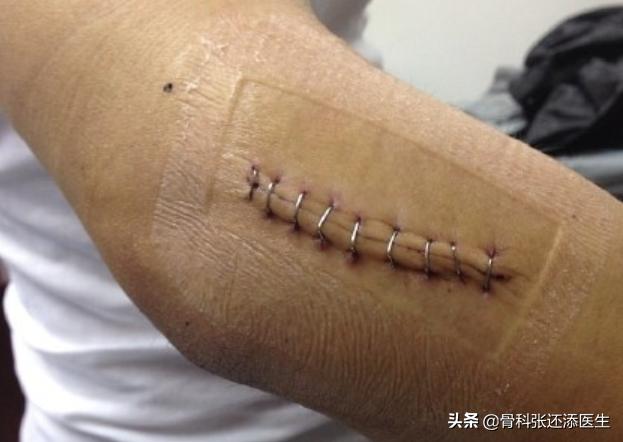 拉链缝合，可吸收止血海绵，这些医疗新科技，你有必要了解