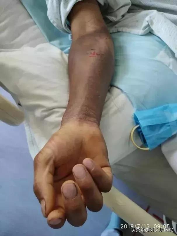 “砰”的一声，我把自己送进了ICU—“一位电击伤患者的自述”