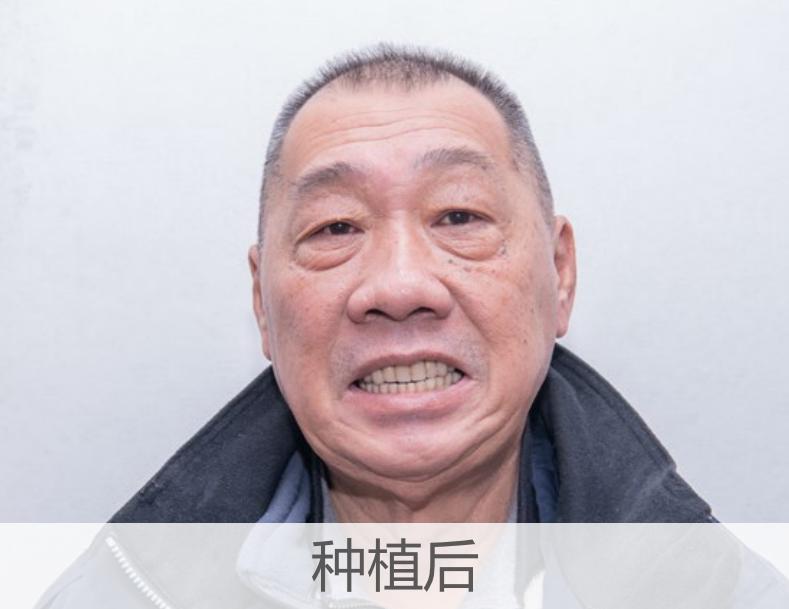 做烤瓷牙如何磨老牙教程,烤瓷牙的正确磨法