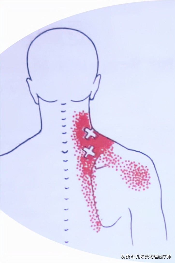 肩膀和肩胛骨疼痛如何治疗,左肩膀和肩胛骨内侧肌肉会疼