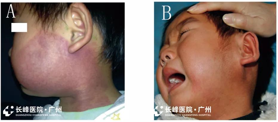 鲜红斑痣的最佳治疗时间是什么时候呢？