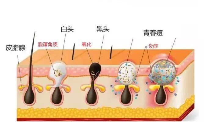 毛孔粗大怎么护肤改善肤质,毛孔粗大怎么护肤才是正确的方法