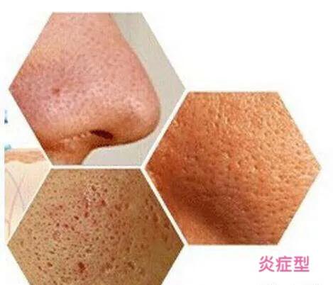 激光缩小毛孔一个疗程多少钱,脸部毛孔缩小做哪个皮肤项目