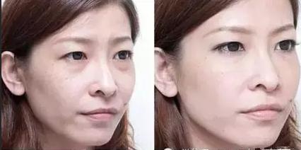 如何去眼袋拥有卧蚕,眼袋卧蚕和泪沟区别