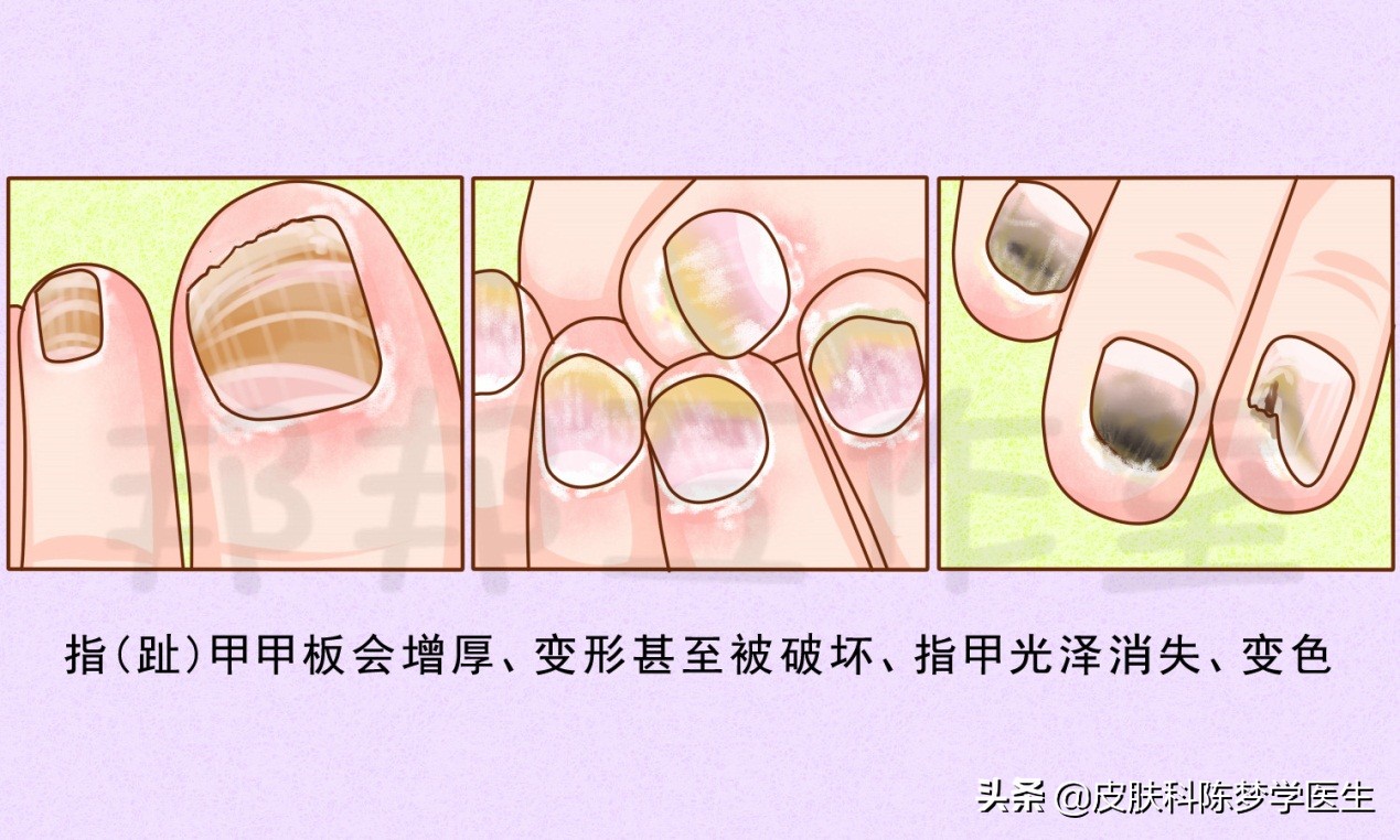 灰指甲用什么外用药好,灰指甲可以用的中医药膏