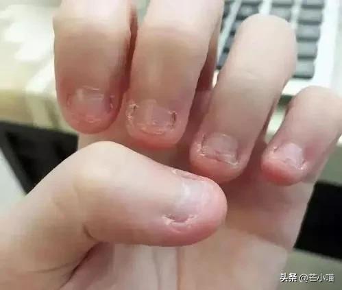 小孩啃手指都啃烂了,小孩把手指头啃得烂的不成样