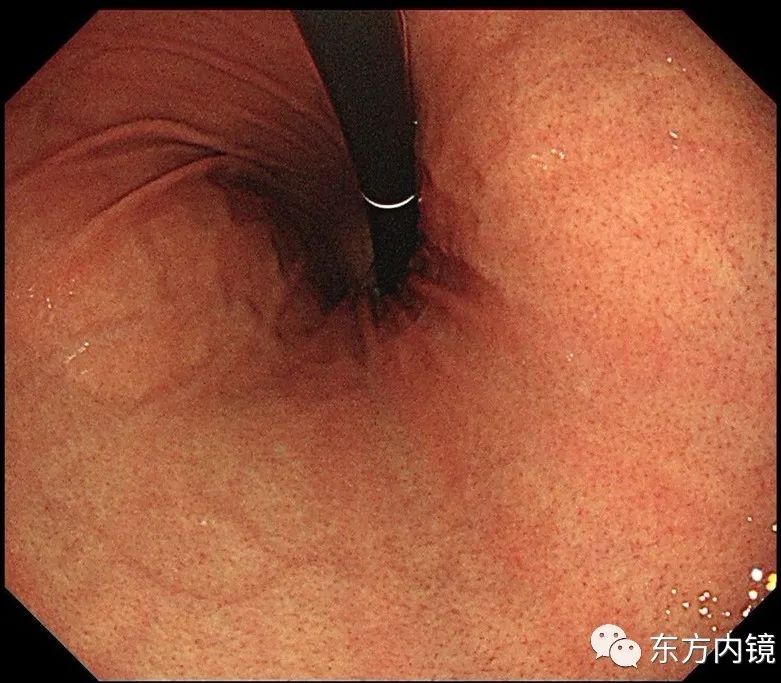 慢性浅表萎缩性胃炎怎么是轻度的,慢性浅表性胃炎中医治疗