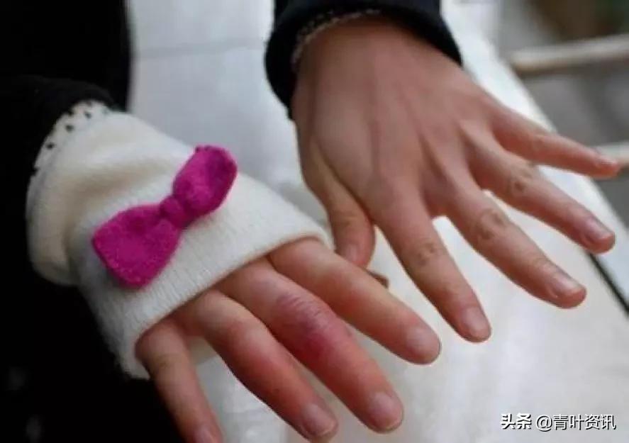 冬季，如何摆脱恼人的冻疮？