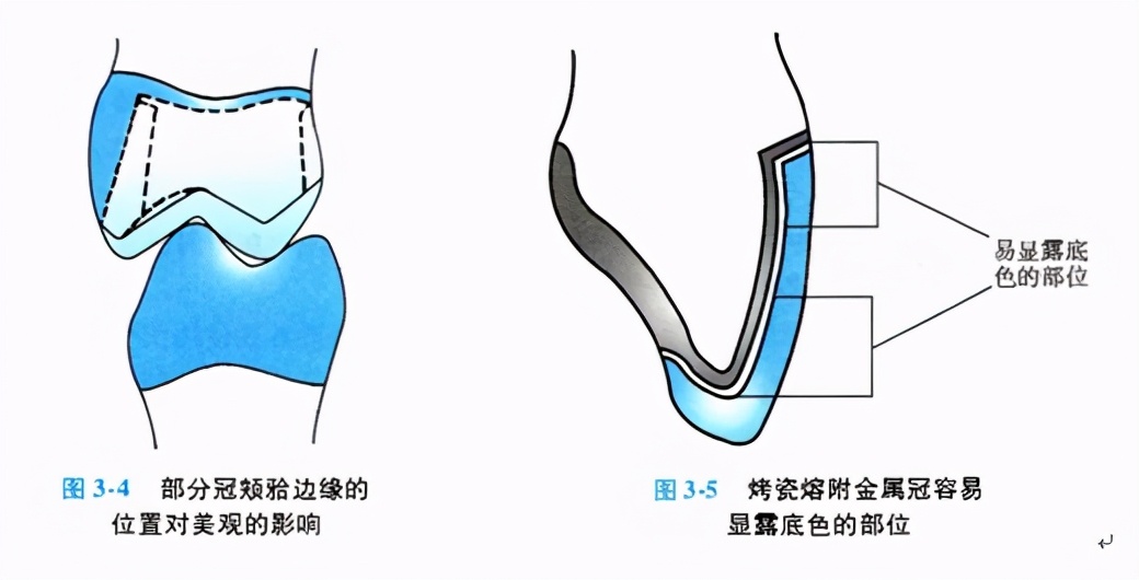 牙齿缺损修复去哪家牙科医院,牙科门牙缺损修复照片