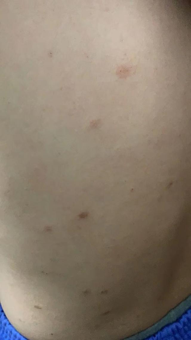 中医治疗皮肤痒的最好方法,中医治疗皮肤纤维瘤