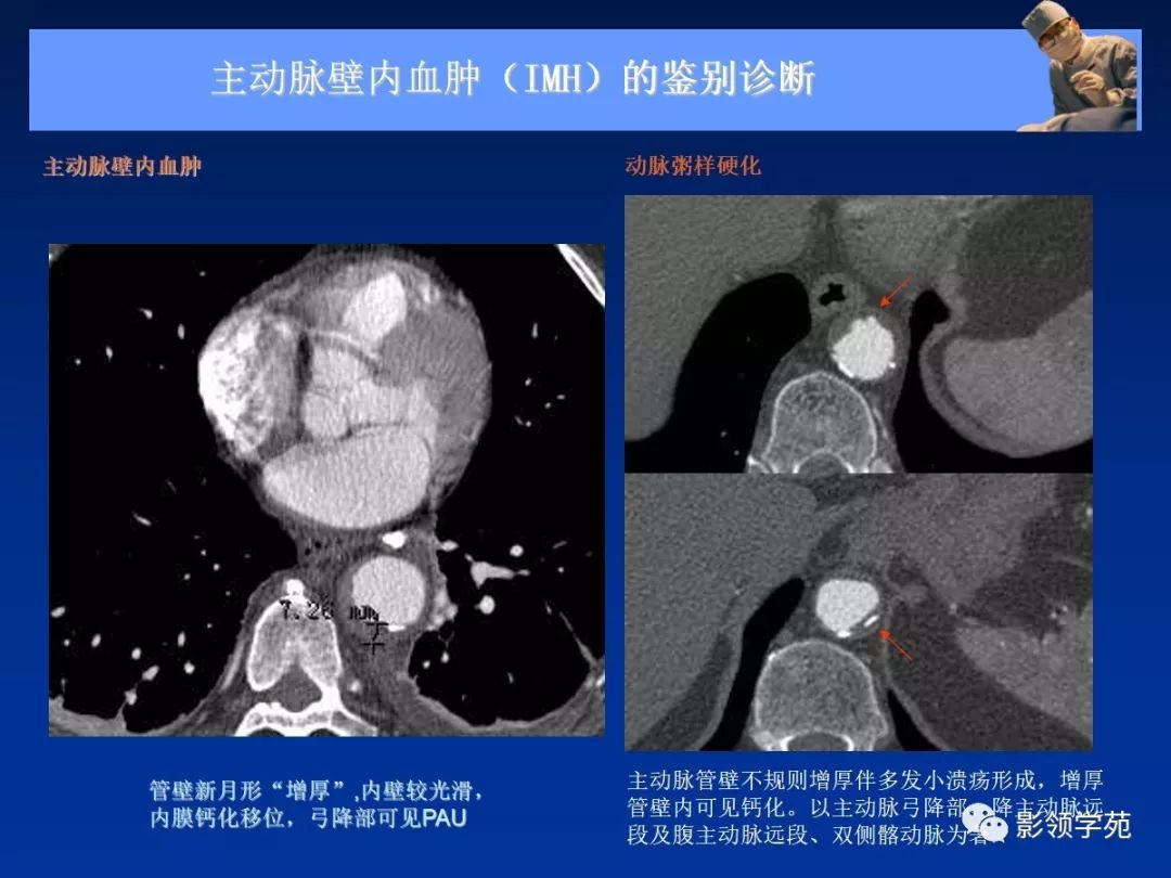 主动脉夹层壁间血肿如何鉴别,主动脉夹层血肿溃疡