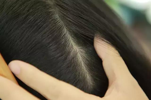 毛囊饿了也脱发，你知道怎样为毛囊补充营养吗？