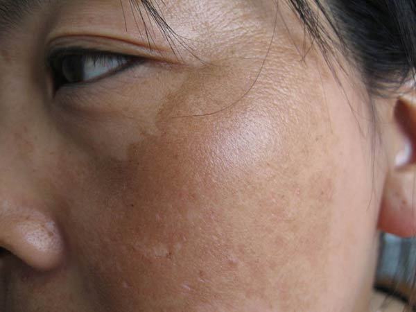 青褐斑怎么内调最好,褐青色斑怎么护理