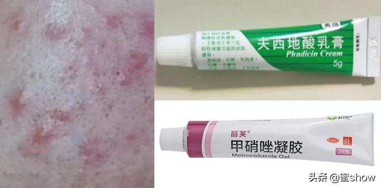 皮肤痘怎么消除,解决皮肤问题对策