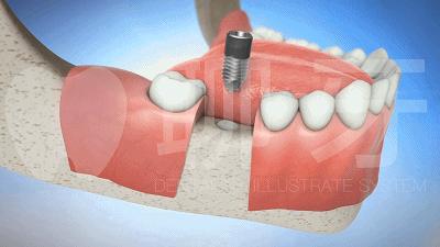 牙齿需要种植牙会经历几个步骤,种植牙流程什么情况需要做骨粉